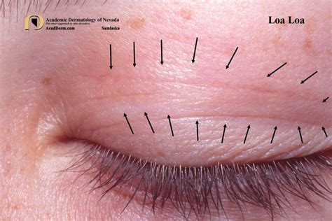 Loiasis: Loa Loa, Tropical Swelling... - Academic Dermatology of Nevada