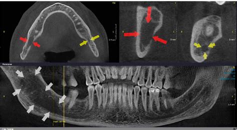 Figure 2 from Common conditions associated with mandibular canal ...