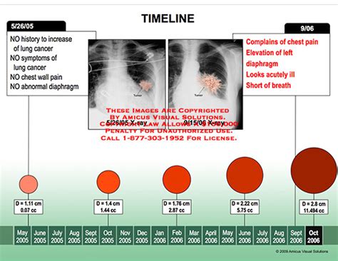 Lung Tumor Size Chart - Best Picture Of Chart Anyimage.Org