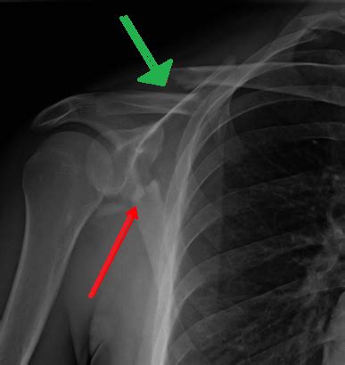 Scapular Fractures - WikiMSK