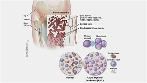 What Is Acute Myeloid Leukemia (AML) Cancer? Refractory and Relapsed ...