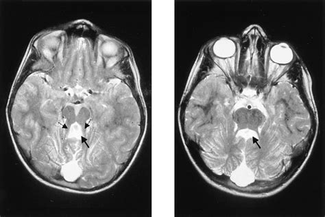 MRI findings in cerebellar vermis agenesis. Left: Axial T 2 -weighted ...