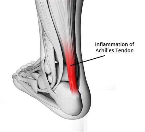 Bike Radar: Tight Achilles Tendon