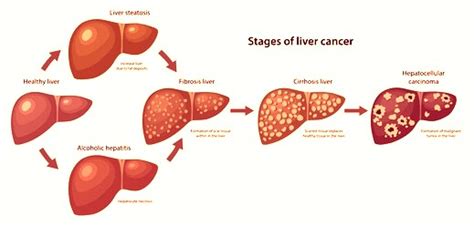 October as Liver Cancer Awareness month: all you need to know about ...