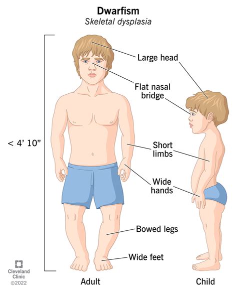 Dwarfism (Skeletal Dysplasia) & Other Causes of Short Stature