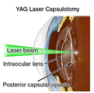 Laser Posterior Capsulotomy – The Royal Victorian Eye and Ear Hospital