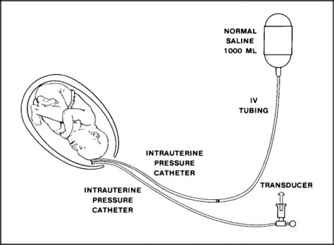 Using Amnioinfusion for the Relief of Repetitive Variable Decelerations ...