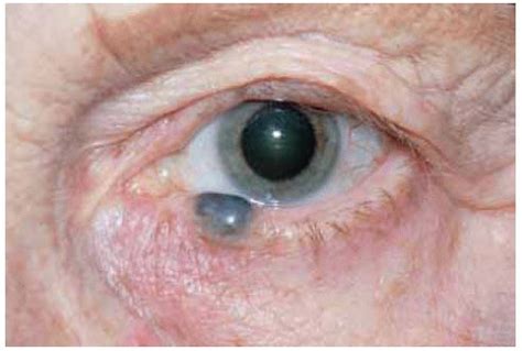 Eyelid Cystic Lesions Simulating Neoplasms | Ento Key