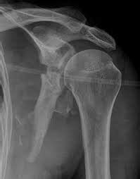 Scapular Fracture Treatment in Kota | ID: 7513231388