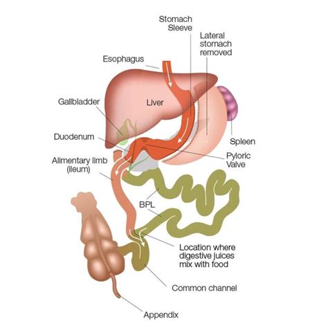 Duodenal Switch Plano, TX - Biliopancreatic Diversion - Texas Center ...