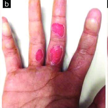 (a) Burn blisters at presentation (b) Deroofing of the burn blister ...