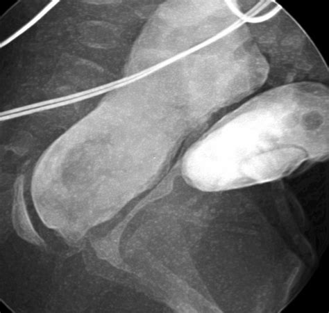 Cloacal malformation