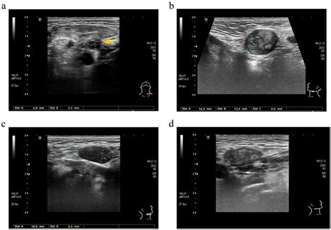 Cervical Lymph Nodes Ultrasound