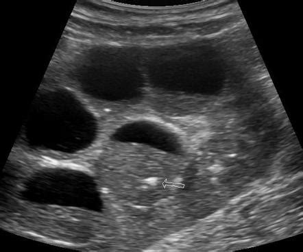 Pyonephrosis | Image | Radiopaedia.org