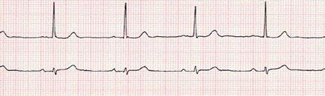 Electrocardiograma: ¿Qué es la Bradicardia Sinusal?