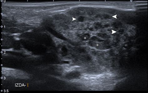 Parotid Gland Parotitis