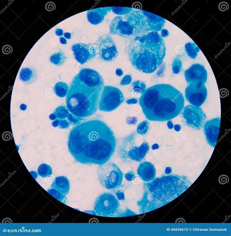 Malignant Cells In Pleural Fluid. Stock Photography | CartoonDealer.com ...