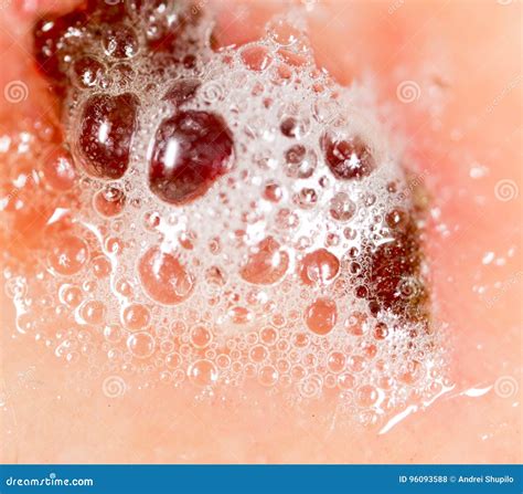 Wound on Human Skin in Hydrogen Peroxide Stock Photo - Image of ...