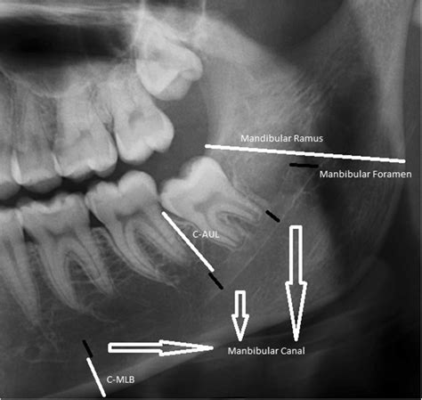 Illustration of measurements made on panoramic radiography | Download ...