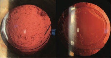 YAG Capsulotomy — Moyes Eye Center