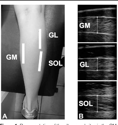 Figure 1 from Muscle Swelling of the Triceps Surae in Response to ...