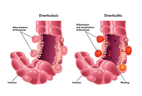 Diverticulitis Abscess