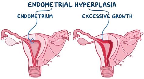 Endometrial hyperplasia, types, causes, symptoms, diagnosis, treatment ...