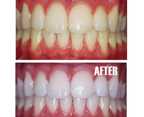 Teeth Whitening Kit online - 9 shades lighter teeth in 2 weeks! | Catch ...