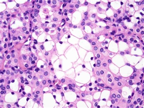 Mucoepidermoid Carcinoma Of Parotid Gland