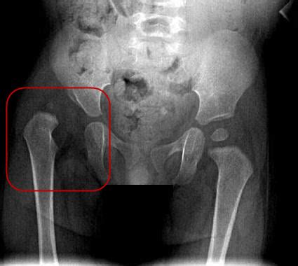 X-ray Screening - International Hip Dysplasia Institute