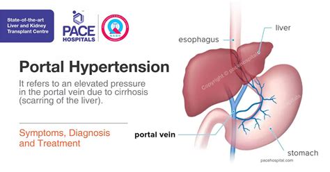 (Portal Hypertension) - Symptoms, Diagnosis and Treatment