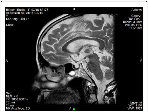 MRI brain of the patient showing partial empty sella. | Download ...