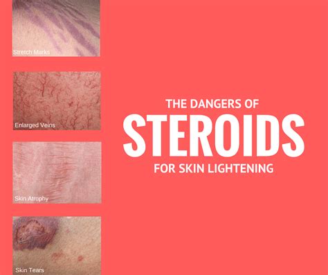 The Risks of Skin Lightening Creams with Steroids