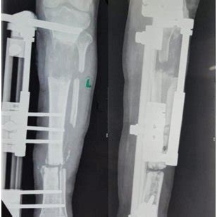 Radiographs following removal of external fixator and correction of ...