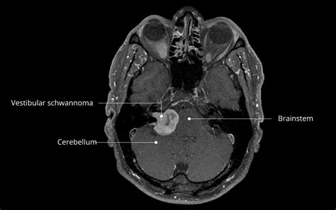 Vestibular schwannoma, acoustic neurinoma | Inselspital Bern