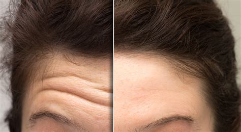 How to Prevent and Reduce Forehead Wrinkles - Spa MD