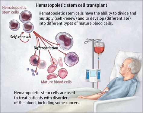 In news: Hematopoietic Stem Cell Transplantations (HSCT)