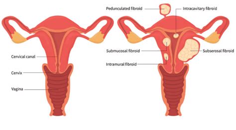 All You Need to Know About Uterine Fibroids Sg Vasular