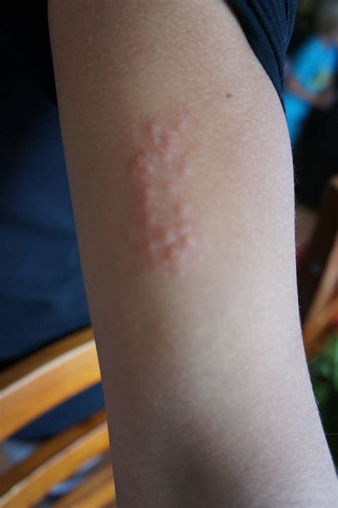 Small Rash Bumps On Arms | Images and Photos finder