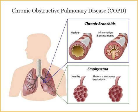 Chronic Obstructive Pulmonary Disease Copd