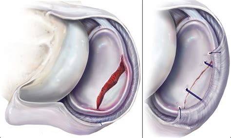 Bony Bankart Lesion | Shoulder Separation - Peter Millett MD ...