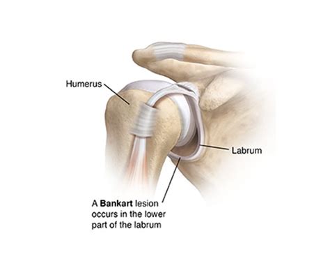 Shoulder Bankart Lesion Treatment Kingston, Surrey UK | Physio & More