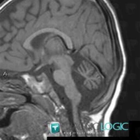 Radiology case : Cerebellar hypoplasia (MRI) - Diagnologic