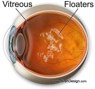 What are floaters in the eye? A detailed patient guide to eye floaters