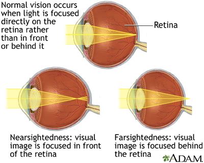 Normal, nearsightedness, and farsightedness: MedlinePlus Medical ...