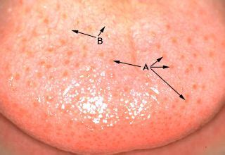 Oral Histology Digital Lab: Mucosa: Dorsum of Adolescent Tongue (Image 17)