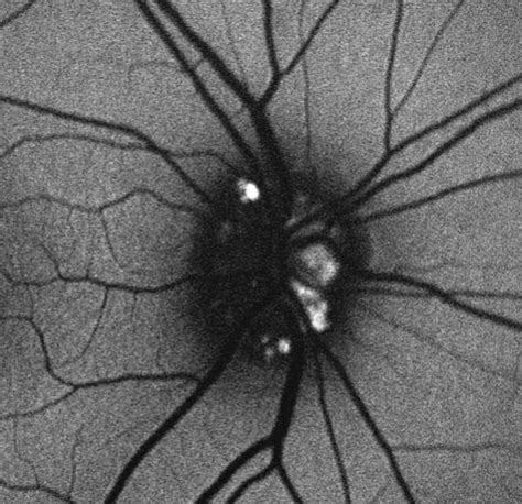 Optic Disc Drusen | Treatment & Management | Point of Care