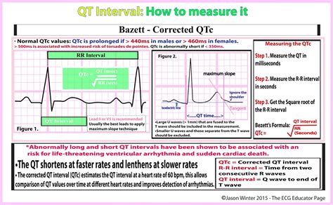 ECG Educator Blog : How to calculate the QTc (Bazett's Formula)