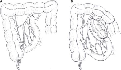 Frontiers | Autologous Intestinal Reconstruction Surgery in Short Bowel ...