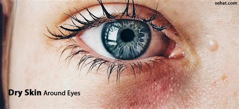 Dry Skin Around Eyes- Causes And Home Remedies